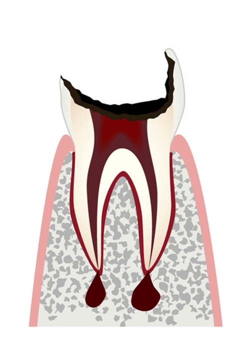 歯の根まで進行した虫歯