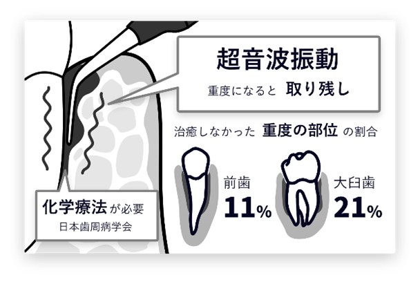 従来の治療は超音波振動のみ