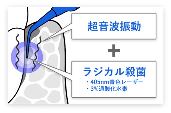 ブルーラジカル治療は超音波振動＋ラジカル殺菌